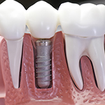 A Basic Introduction to Dental Implants