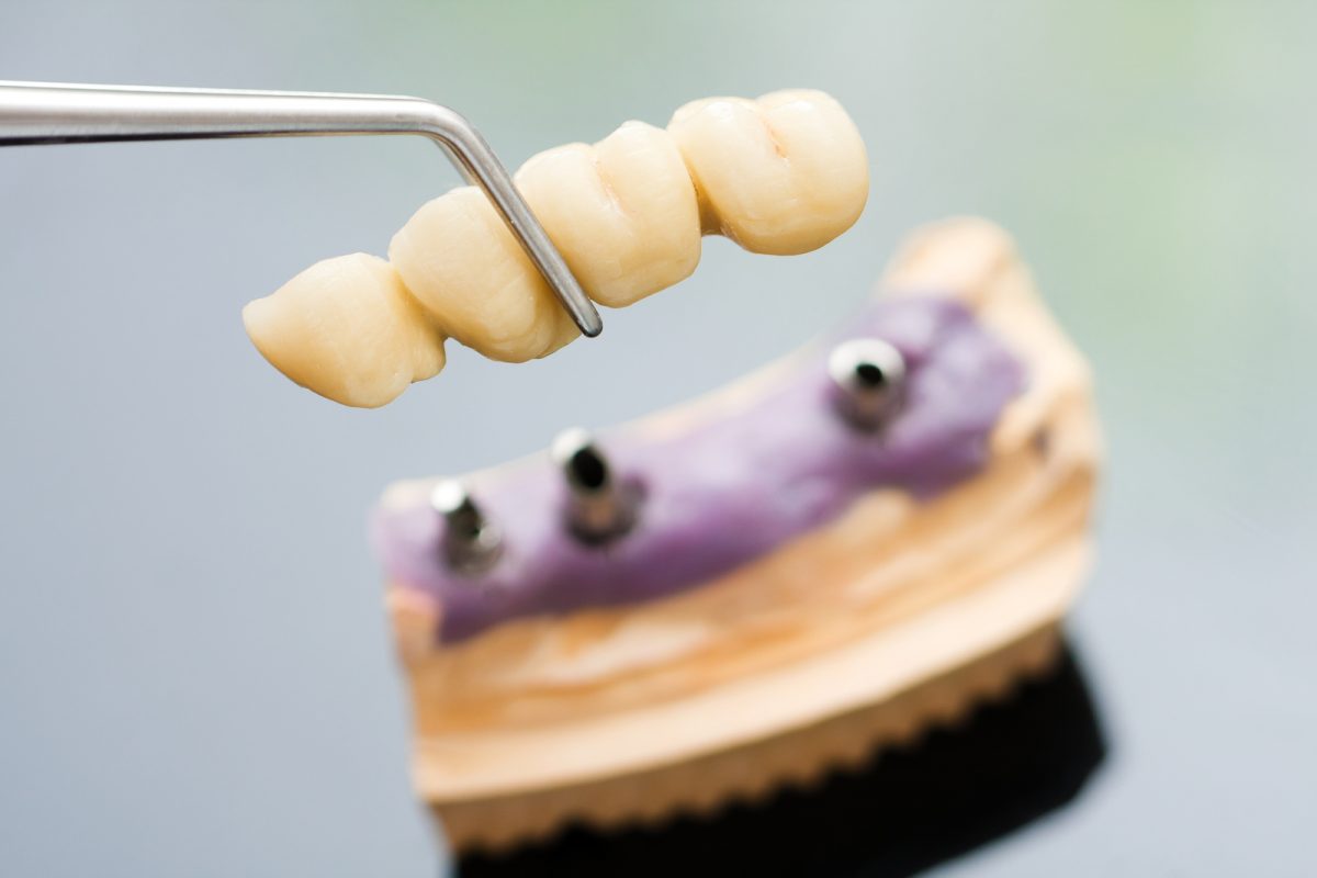How effective are Dental Implants