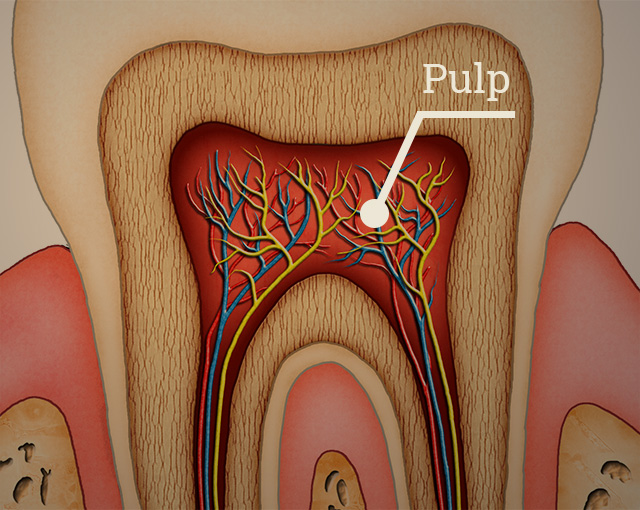 root-canal-img1