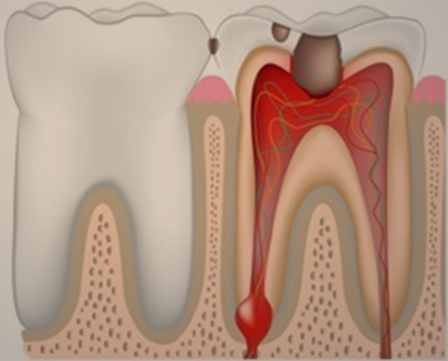 root-canal-img2