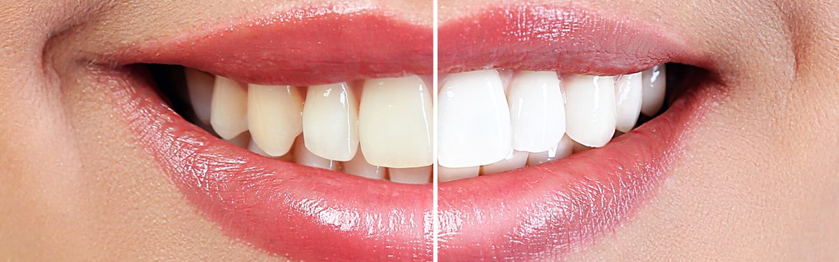 Brighten Your Smile with Teeth Whitening!