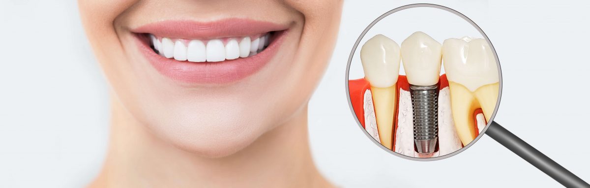 Gum Disease is Still a Threat to Your Dental Implants