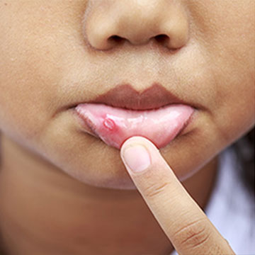 Canker Sores Treatment in NW Calgary