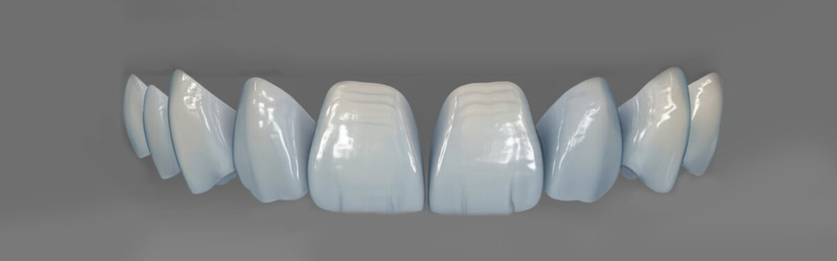 What Are Porcelain Veneers, and How Do They Work?