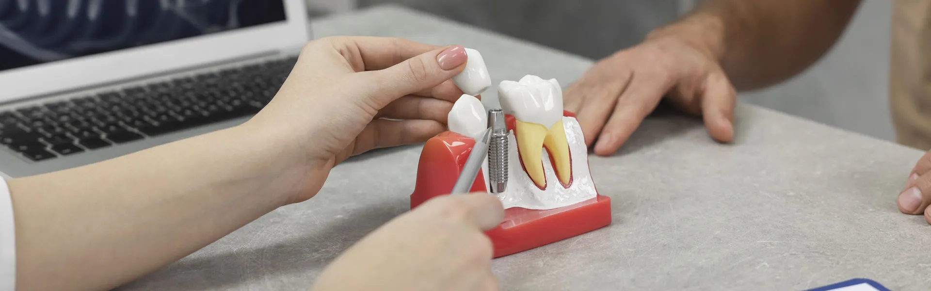 Transform Your Smile with Dental Implants in Calgary